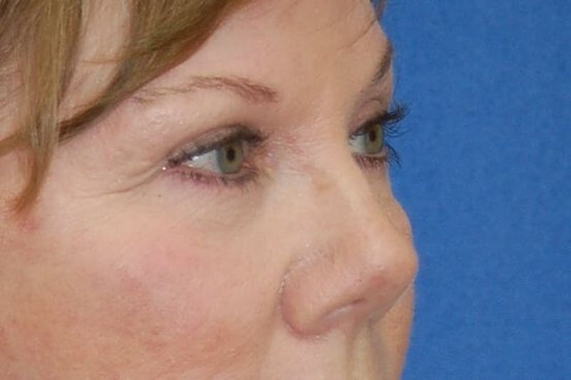 Eyelid Surgery Before & After Gallery - Patient 90005916 - Image 6