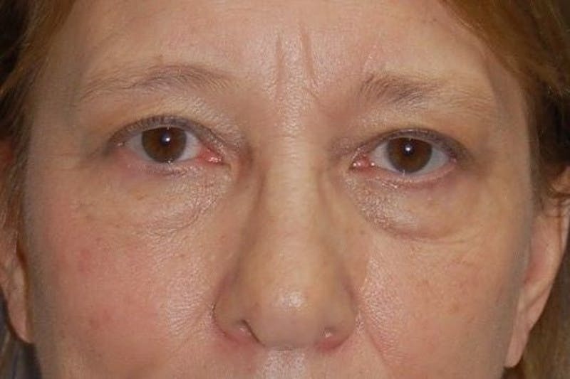 Eyelid Surgery Before & After Gallery - Patient 90006093 - Image 1