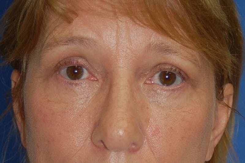 Eyelid Surgery Before & After Gallery - Patient 90006093 - Image 2