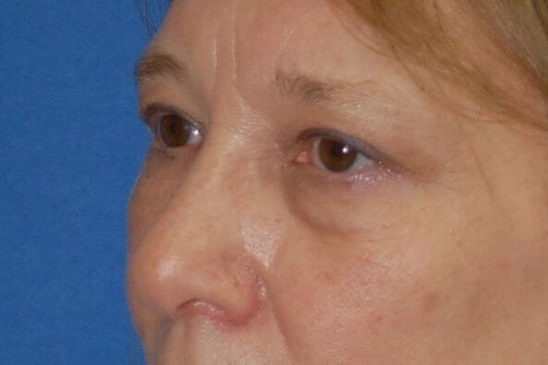 Eyelid Surgery Before & After Gallery - Patient 90006093 - Image 3