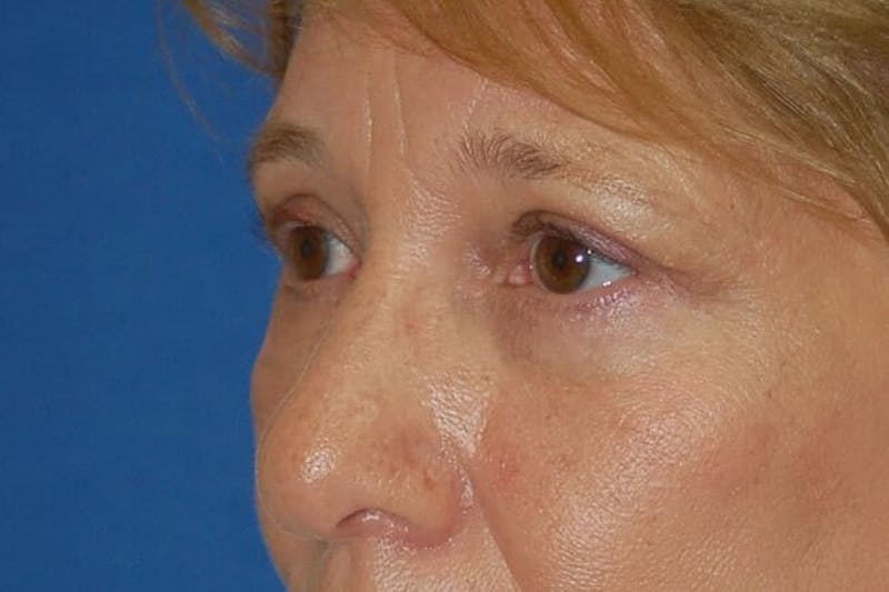 Eyelid Surgery Before & After Gallery - Patient 90006093 - Image 4