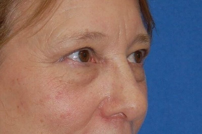 Eyelid Surgery Before & After Gallery - Patient 90006093 - Image 5