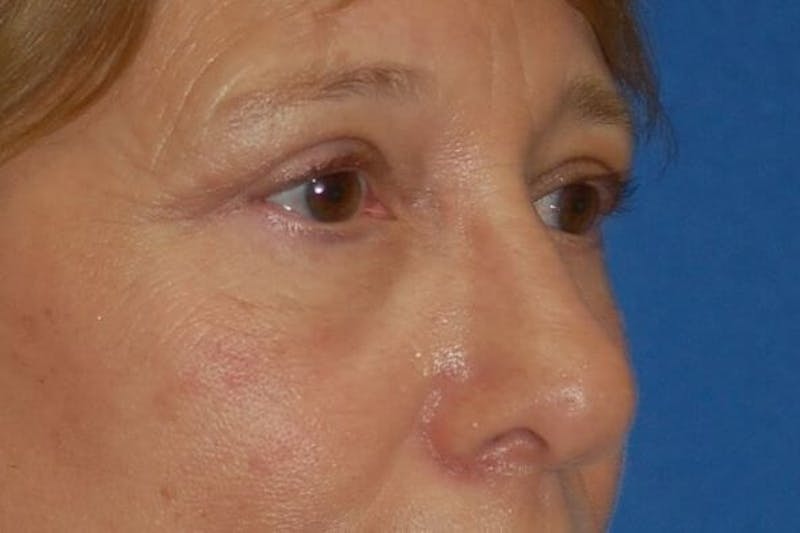 Eyelid Surgery Before & After Gallery - Patient 90006093 - Image 6