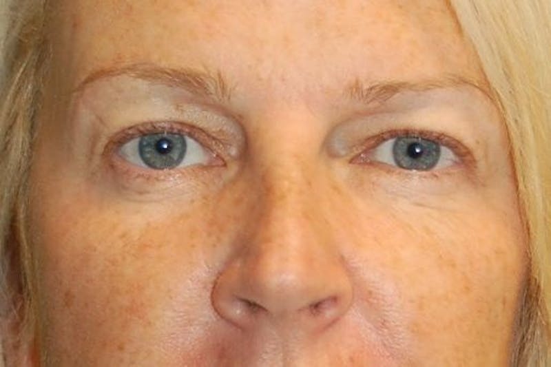 Eyelid Surgery Gallery - Patient 90006094 - Image 1