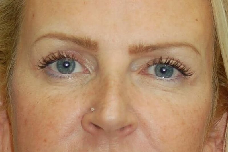 Eyelid Surgery Before & After Gallery - Patient 90006094 - Image 2