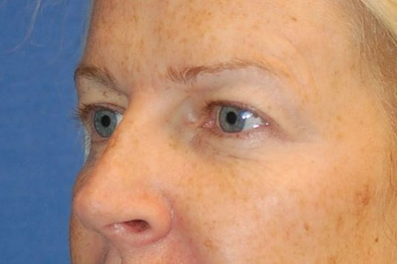 Eyelid Surgery Before & After Gallery - Patient 90006094 - Image 3