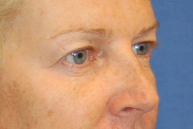 Eyelid Surgery Gallery - Patient 90006094 - Image 5