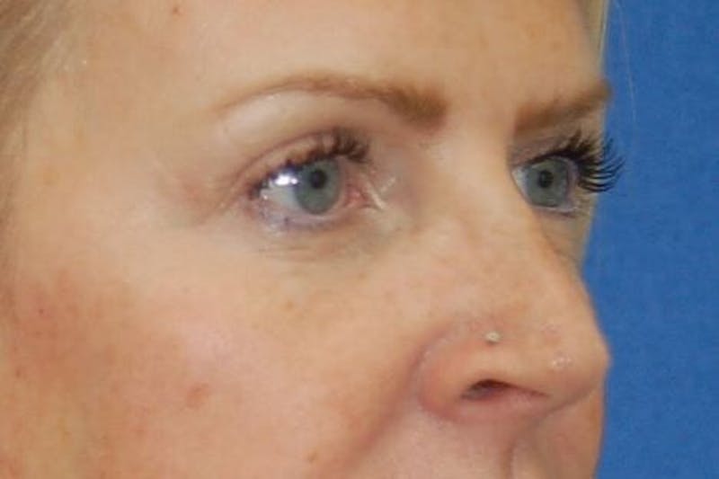 Eyelid Surgery Before & After Gallery - Patient 90006094 - Image 6