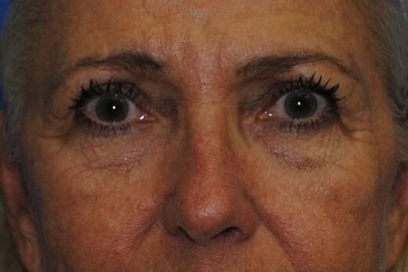 Eyelid Surgery Before & After Gallery - Patient 90006095 - Image 1