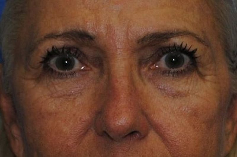 Eyelid Surgery Before & After Gallery - Patient 90006095 - Image 1