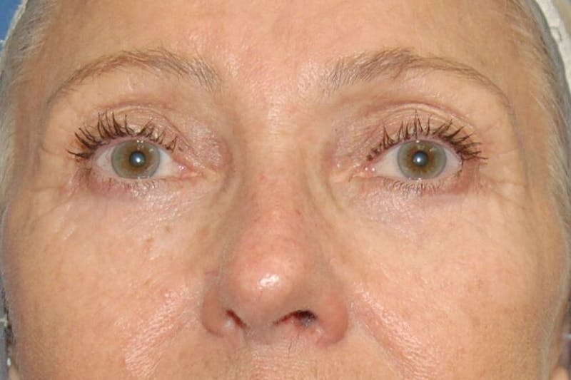 Eyelid Surgery Before & After Gallery - Patient 90006095 - Image 2