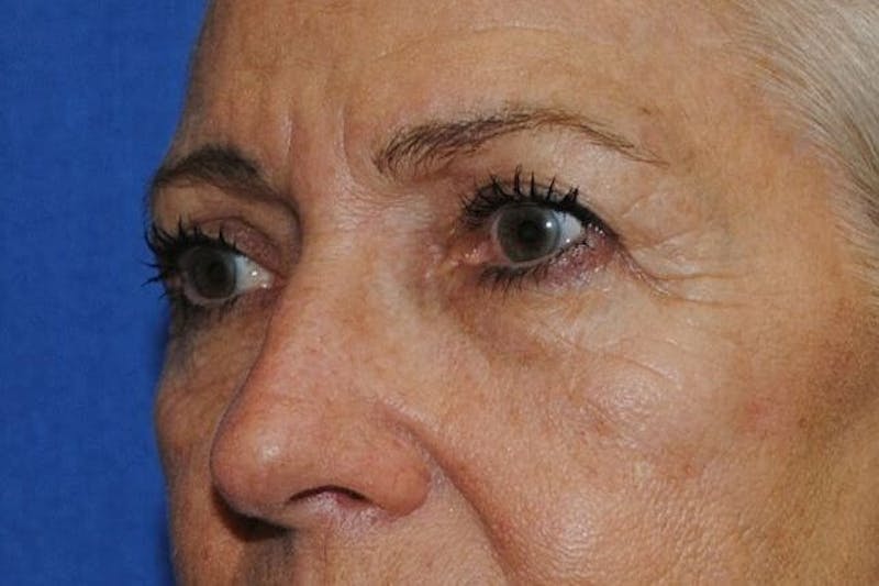 Eyelid Surgery Before & After Gallery - Patient 90006095 - Image 3