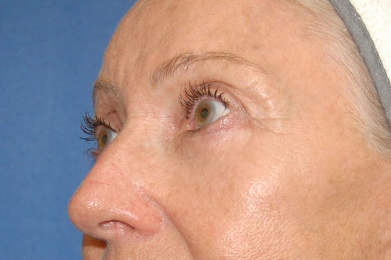 Eyelid Surgery Before & After Gallery - Patient 90006095 - Image 4