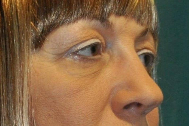 Eyelid Surgery Before & After Gallery - Patient 90006096 - Image 3