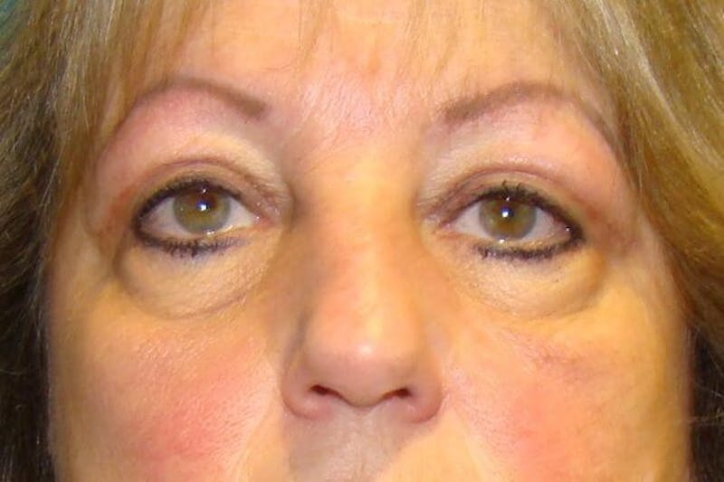 Eyelid Surgery Before & After Gallery - Patient 90006097 - Image 2