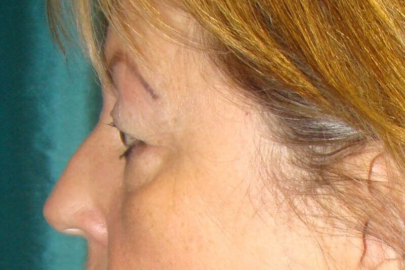 Eyelid Surgery Before & After Gallery - Patient 90006097 - Image 3
