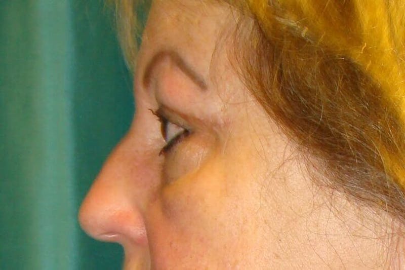 Eyelid Surgery Before & After Gallery - Patient 90006097 - Image 4