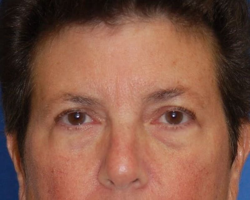 Eyelid Surgery Before & After Gallery - Patient 90006113 - Image 1