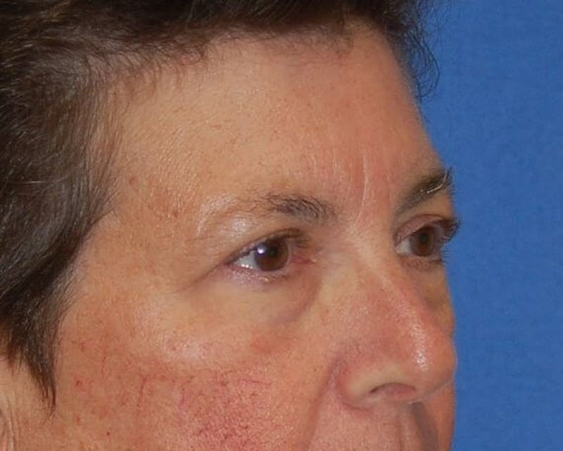 Eyelid Surgery Before & After Gallery - Patient 90006113 - Image 3