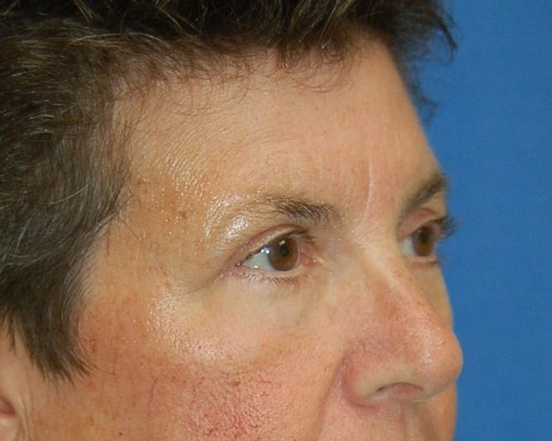 Eyelid Surgery Before & After Gallery - Patient 90006113 - Image 4