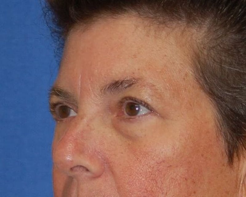 Eyelid Surgery Before & After Gallery - Patient 90006113 - Image 5