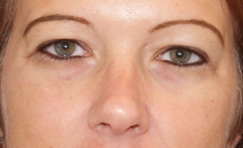 Eyelid Surgery Before & After Gallery - Patient 90006114 - Image 1