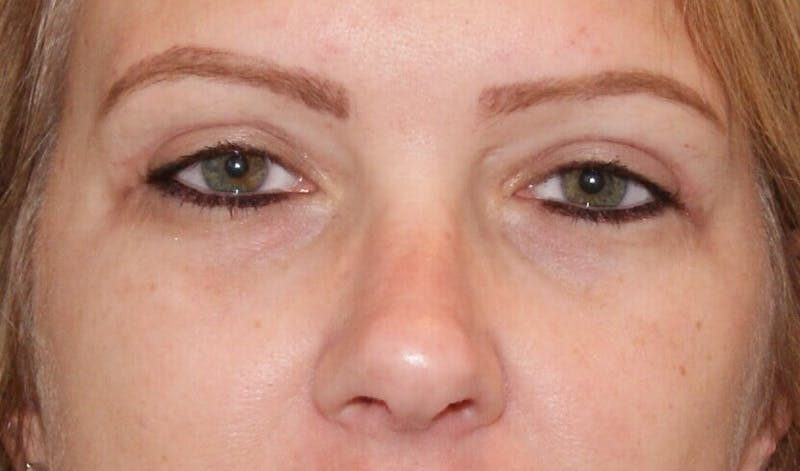 Eyelid Surgery Before & After Gallery - Patient 90006114 - Image 2