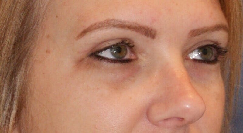 Eyelid Surgery Before & After Gallery - Patient 90006114 - Image 4