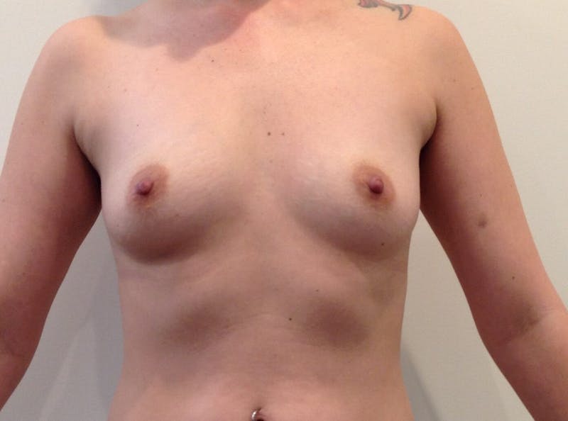 Breast Augmentation Before & After Gallery - Patient 90006139 - Image 1