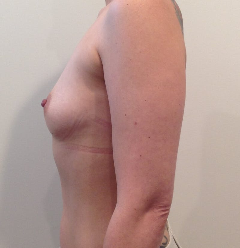 Breast Augmentation Before & After Gallery - Patient 90006139 - Image 3