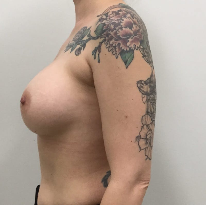 Breast Augmentation Before & After Gallery - Patient 90006139 - Image 4