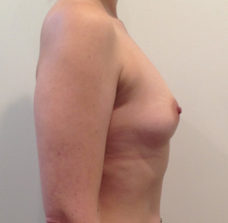 Breast Augmentation Before & After Gallery - Patient 90006139 - Image 5
