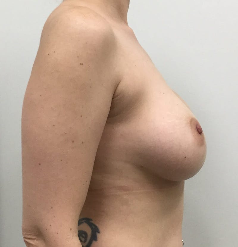 Breast Augmentation Before & After Gallery - Patient 90006139 - Image 6