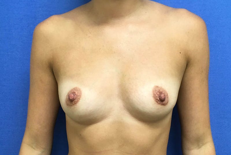 Breast Augmentation Before & After Gallery - Patient 90006192 - Image 1