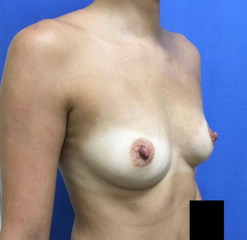 Breast Augmentation Before & After Gallery - Patient 90006192 - Image 3