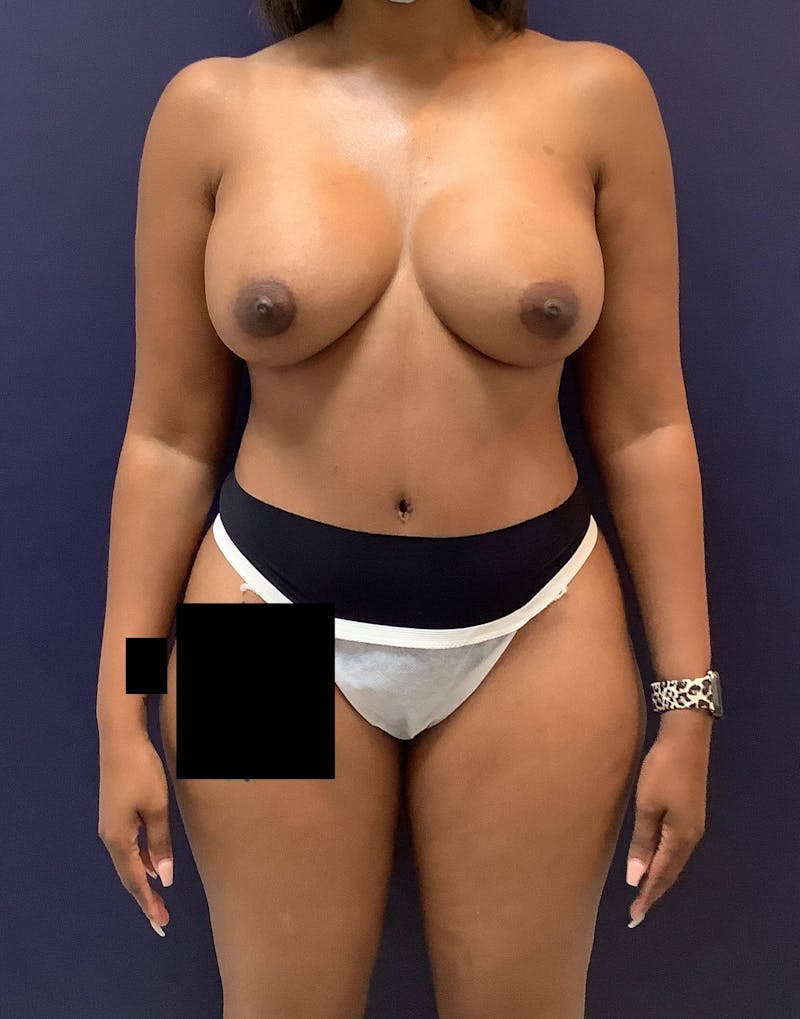 Breast Augmentation Before & After Gallery - Patient 90006199 - Image 2