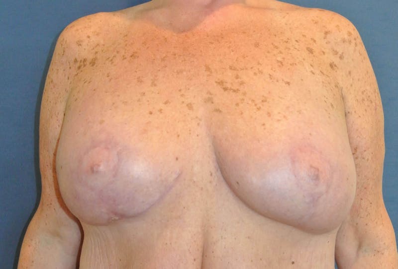 Breast Augmentation Before & After Gallery - Patient 90006201 - Image 2