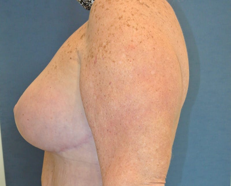 Breast Augmentation Before & After Gallery - Patient 90006201 - Image 4