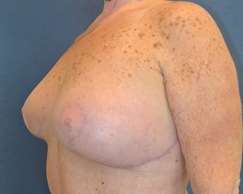 Breast Augmentation Before & After Gallery - Patient 90006201 - Image 6