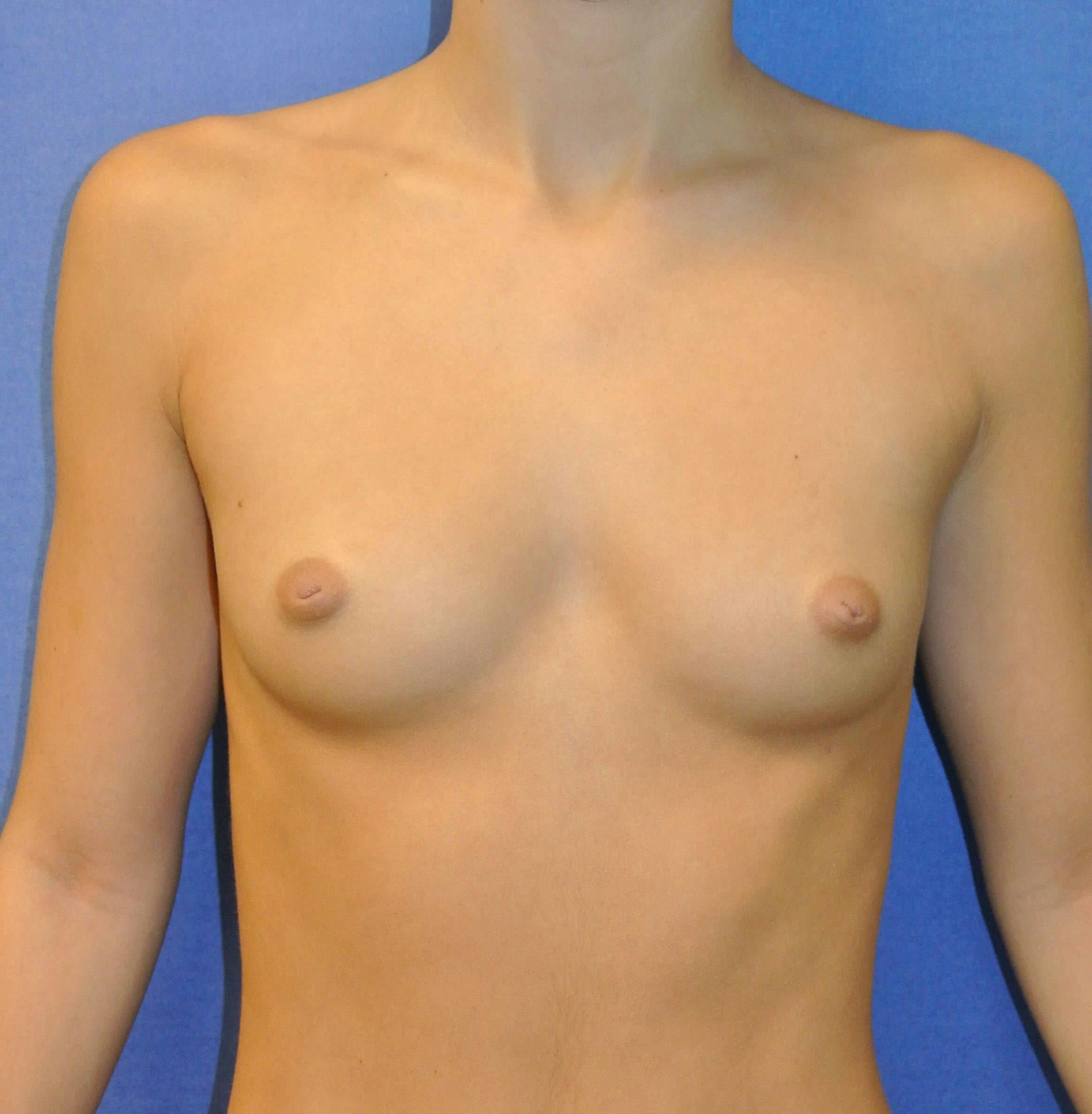 Breast Augmentation Gallery - Patient 90006208 - Image 1