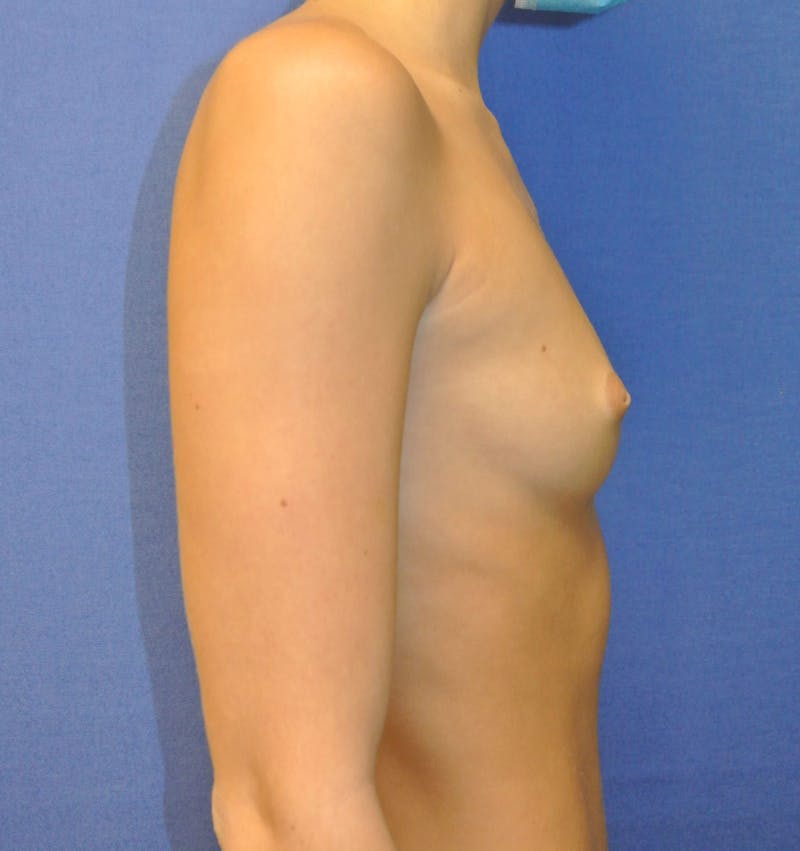 Breast Augmentation Before & After Gallery - Patient 90006208 - Image 3