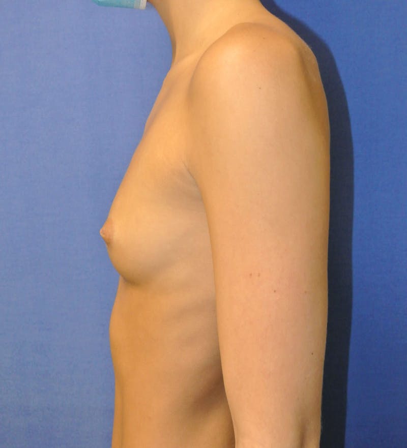 Breast Augmentation Before & After Gallery - Patient 90006208 - Image 5