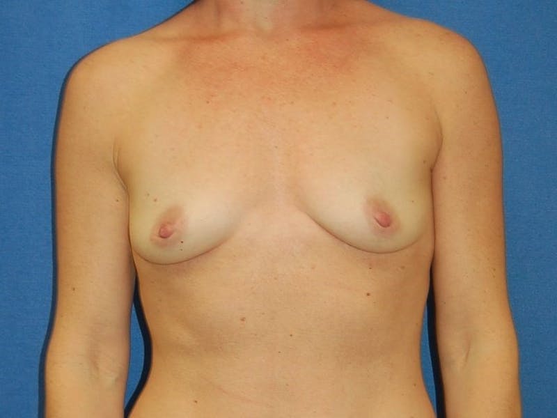 Breast Augmentation Before & After Gallery - Patient 90006246 - Image 1