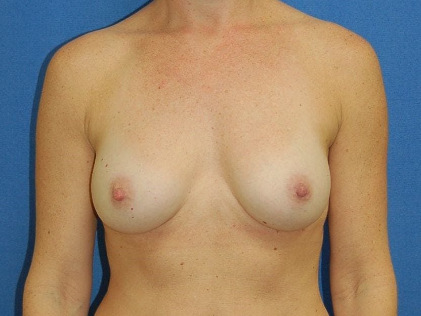 Breast Augmentation Gallery - Patient 90006246 - Image 2