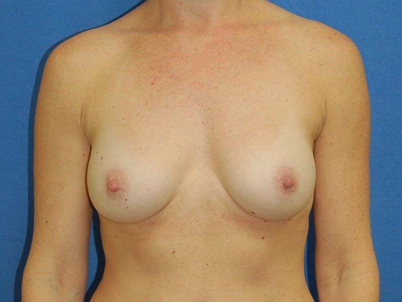 Breast Augmentation Before & After Gallery - Patient 90006246 - Image 2
