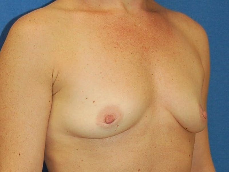 Breast Augmentation Before & After Gallery - Patient 90006246 - Image 5
