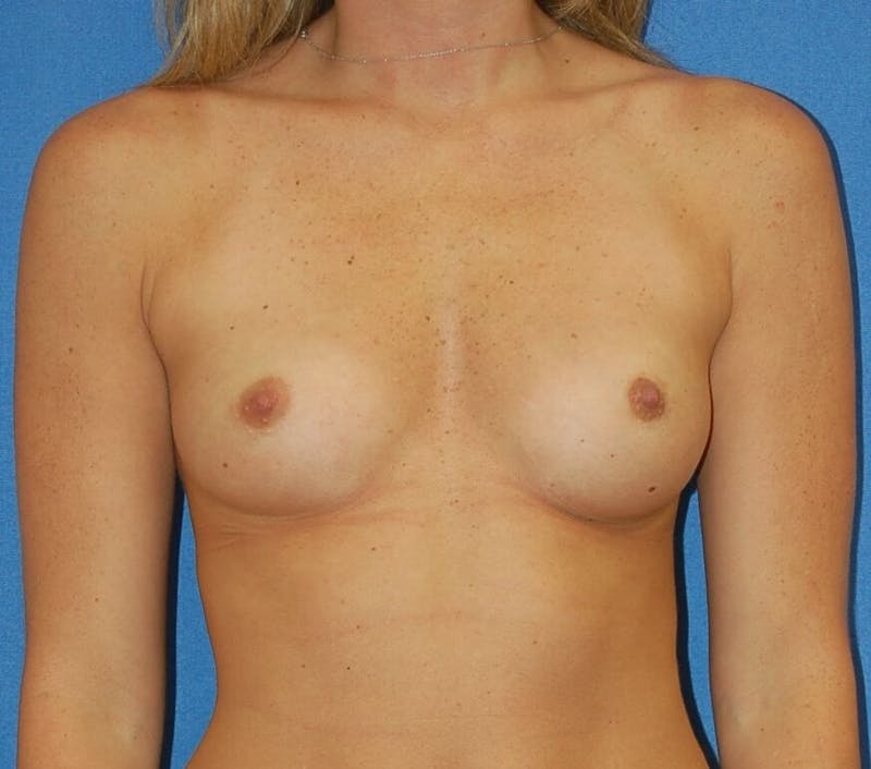 Breast Augmentation Before & After Gallery - Patient 90006249 - Image 1