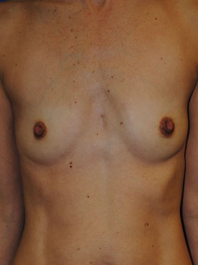 Breast Augmentation Before & After Gallery - Patient 90006252 - Image 1