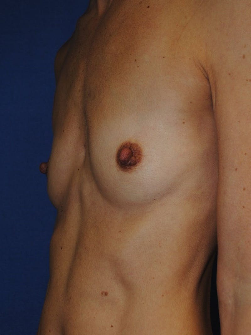 Breast Augmentation Before & After Gallery - Patient 90006252 - Image 3