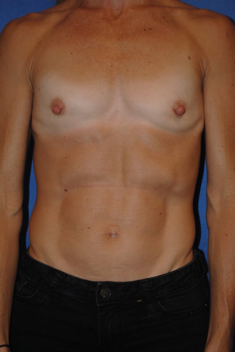 Breast Augmentation Before & After Gallery - Patient 90006254 - Image 1